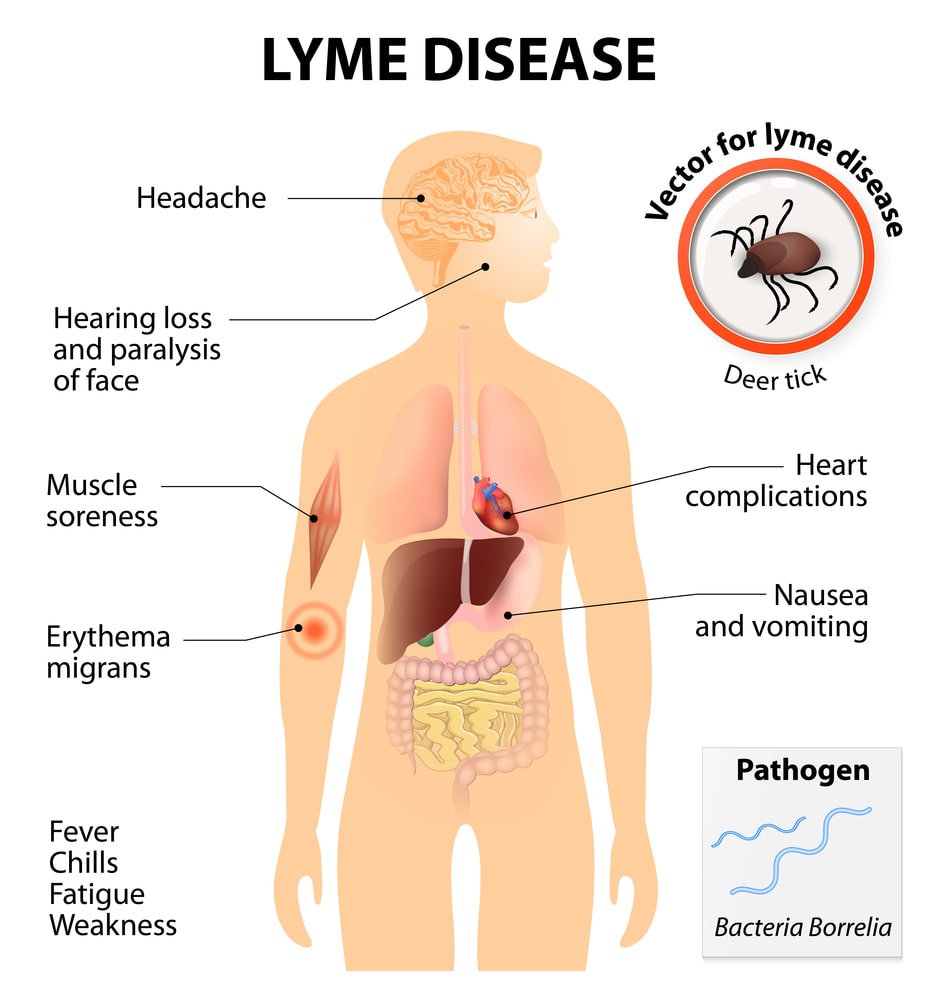 Lyme disease's long-term effects