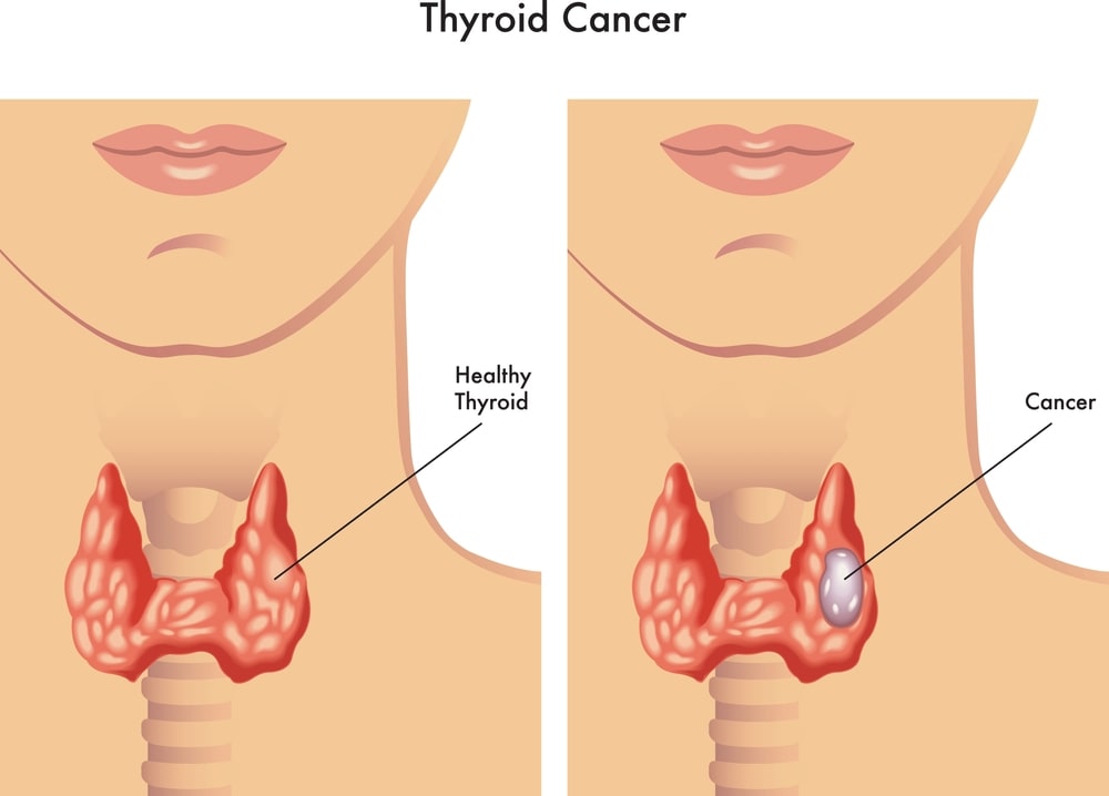 Thyroid cancer